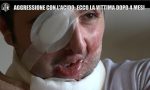 Aggressione con l’acido a Legnano, Olgiati chiede giustizia per Giuseppe