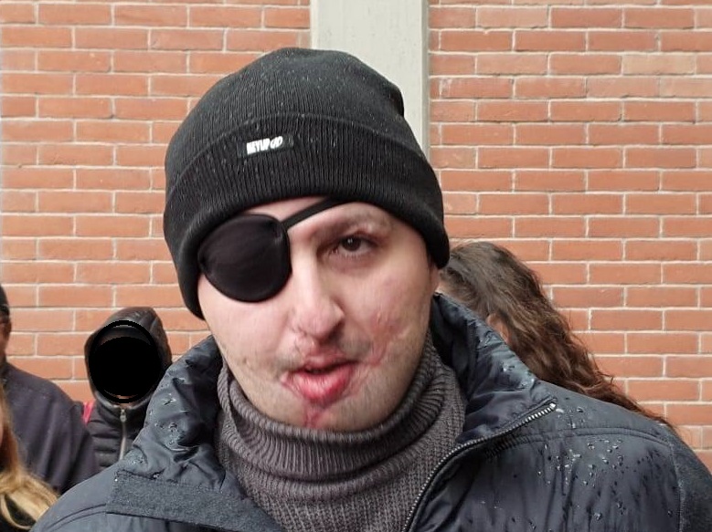 Sfregiato con l’acido dalla ex: “Serve un fondo di garanzia per le vittime”