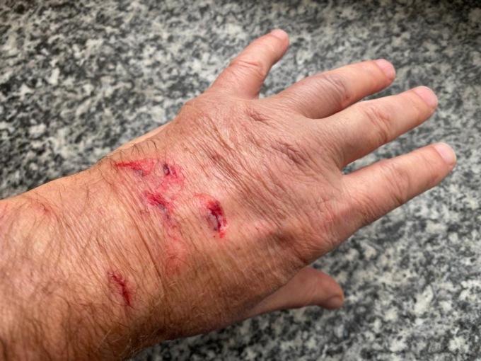 Aggredito dai ladri che gli feriscono la mano
